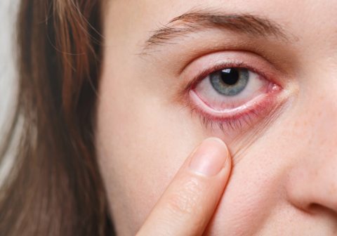 chica de ojos azules mostrando sus ojos rojos